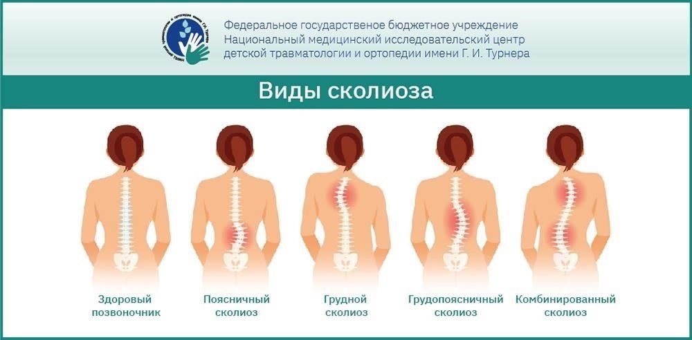 Диагностика ювенильного идиопатического искривления позвоночника: Что ожидать от визита к врачу