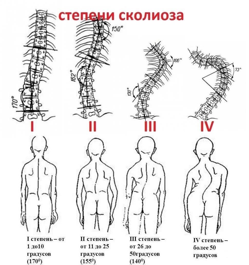 Для людей с деформацией позвоночника варианты лечения могут повлиять на их пригодность к службе в вооруженных силах. Несколько терапевтических методов направлены на облегчение симптомов и управление прогрессированием заболевания, что потенциально может повлиять на пригодность к службе в армии.