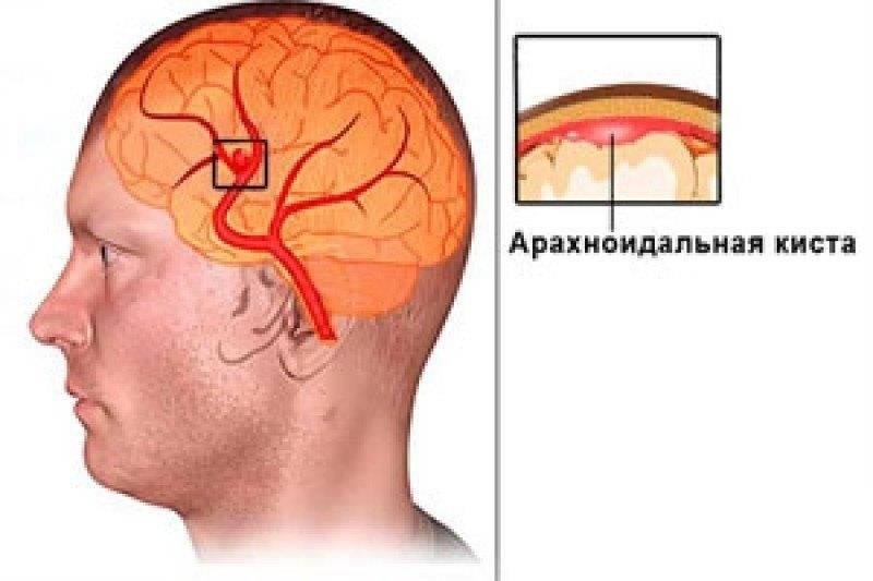 Как подготовиться к медицинскому обследованию с диагнозом «арахноидальная киста»Для людей с диагнозом «арахноидальная киста» крайне важно подойти к процессу медицинского обследования с тщательной подготовкой. Наличие этого заболевания может вызвать вопросы о его влиянии на военную пригодность, особенно в связи с такими постоянными проблемами, как головокружение или частые головные боли.