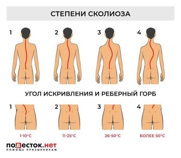 Как подростковый идиопатический сколиоз влияет на пригодность к военной службе