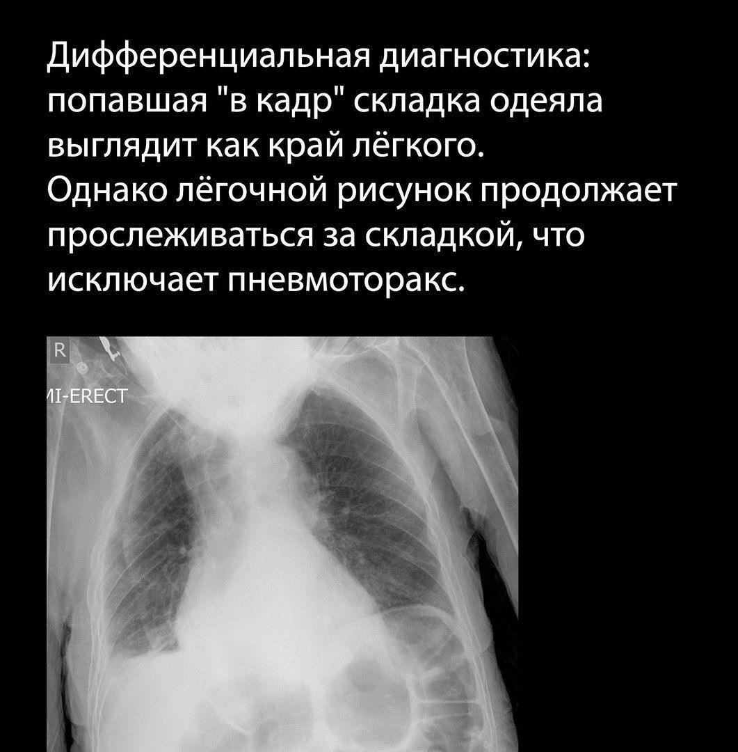 Клиническая картина и диагностика травматического пневмоторакса и гемоторакса