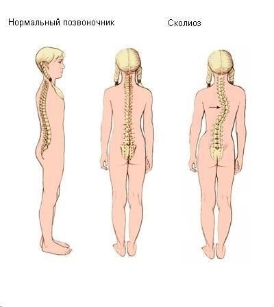 Понимание причин и развития ювенильного идиопатического искривления позвоночника