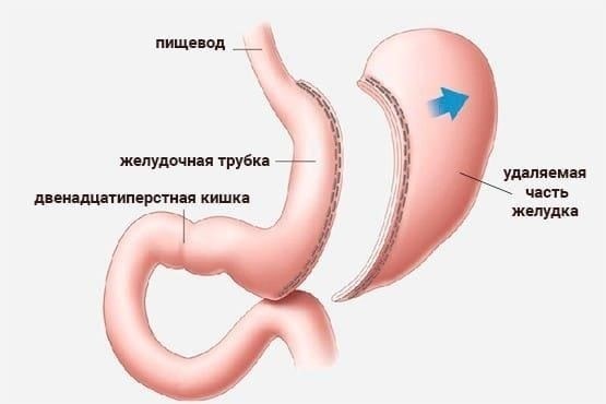 При травмах желудочно-кишечного тракта крайне важны быстрая диагностика и лечение. Неотложная медицинская помощь должна быть направлена на оценку тяжести повреждений, особенно таких органов, как печень, желчный пузырь и кишечник. Начните со стабилизации состояния пациента, обеспечения контроля кровотечения и поддержания жизненно важных показателей.