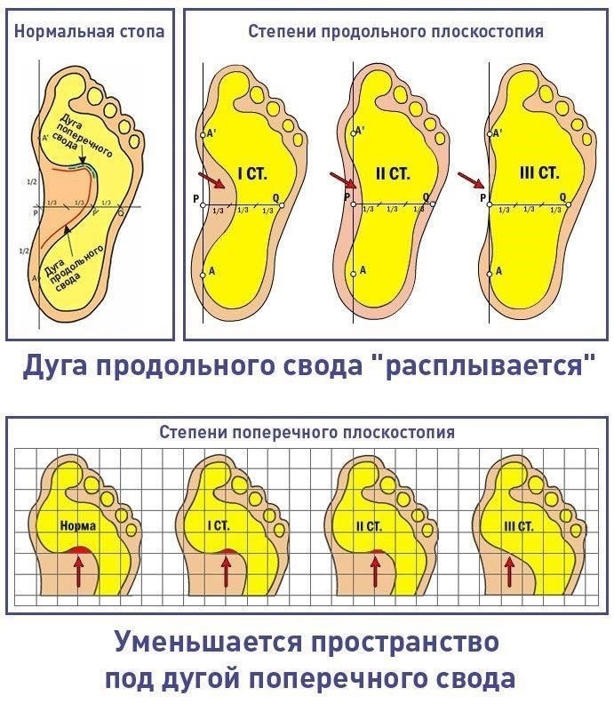 Пригодность к службе в армии при плоскостопии 3-й степени: что нужно знать